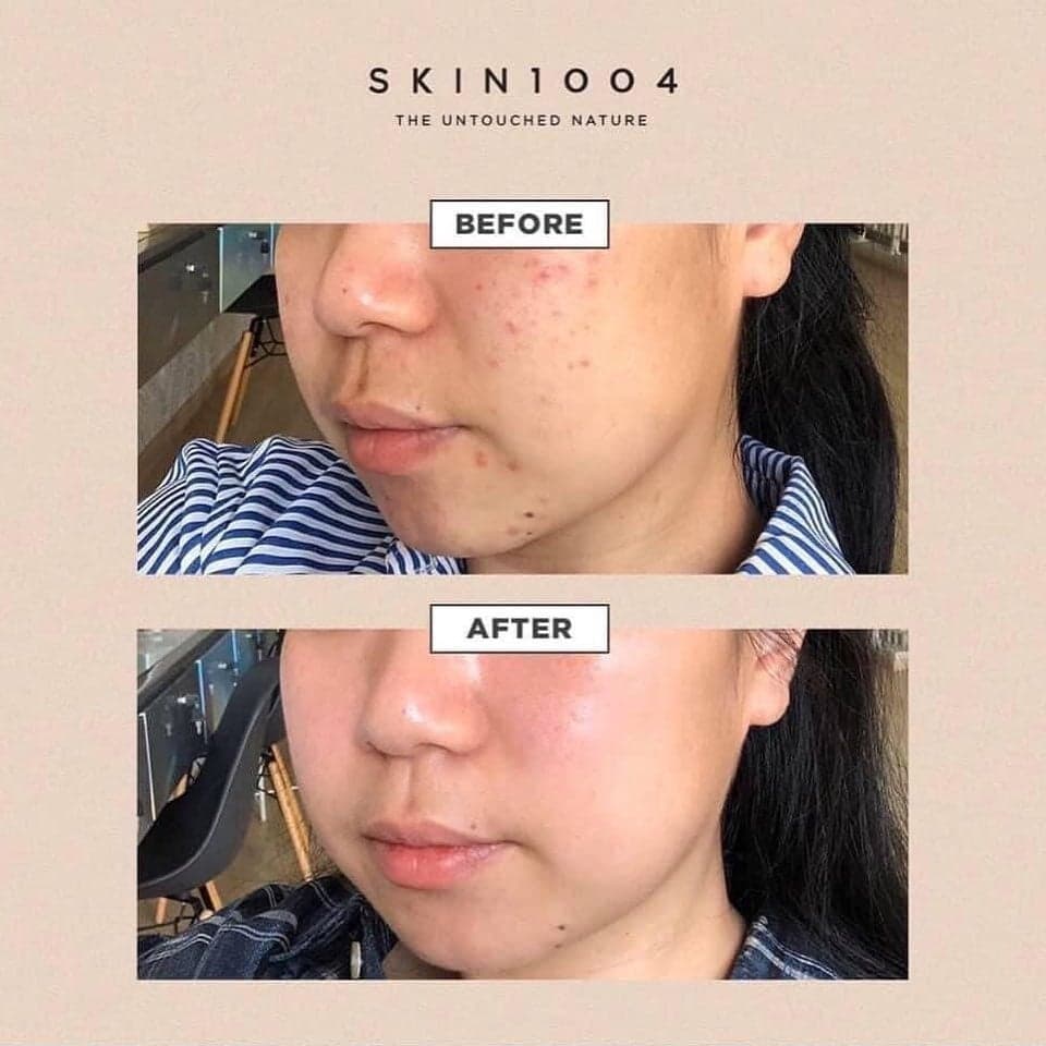 Tinh chất rau má Madagascar skin1004 Centella Ampoule|100ml cam kết hàng đúng mô tả chất lượng đảm bảo an toàn đến sức khỏe người sử dụng đa dạng mẫu mã màu sắc kích cỡ